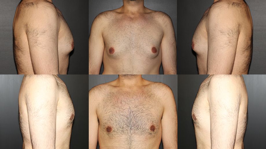 gynecomastia-1
