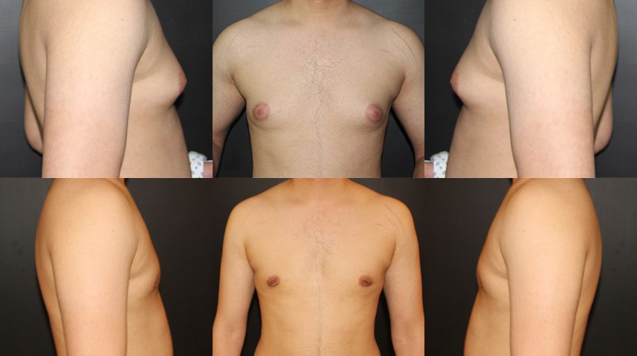 gynecomastia-2