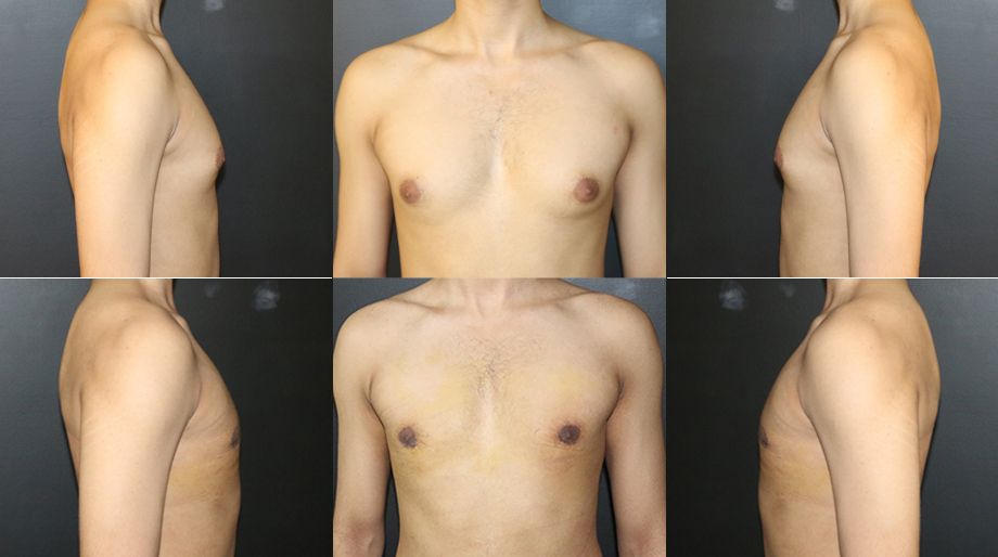 gynecomastia-3