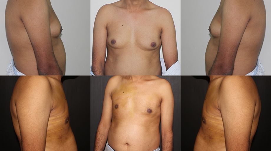 gynecomastia-4